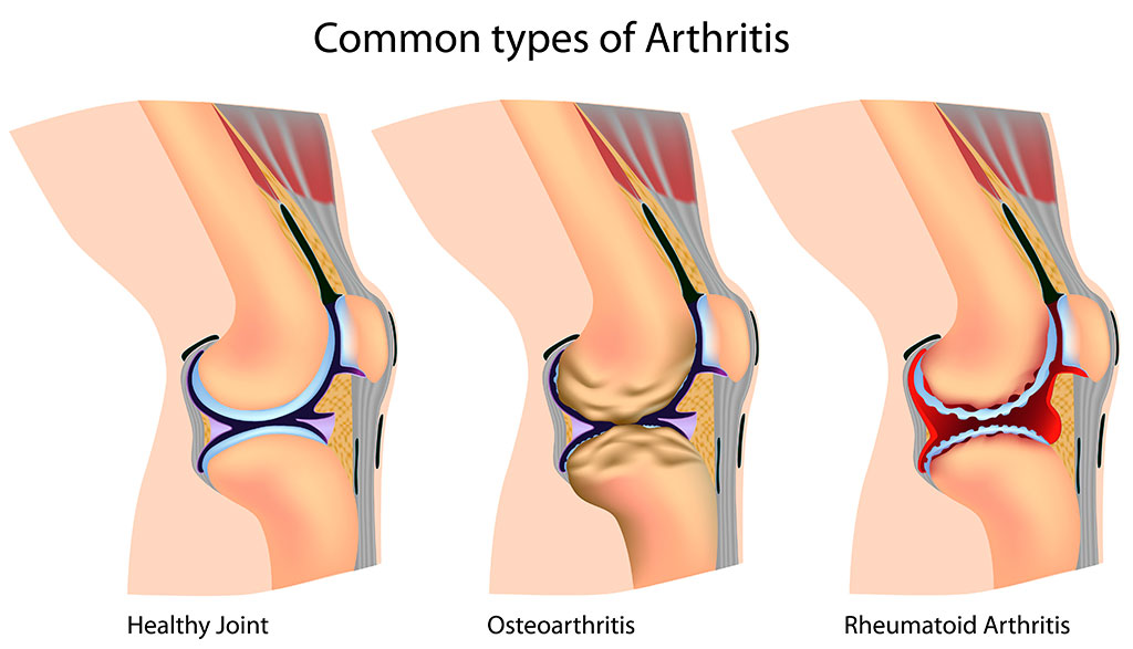 Common types of Arthritis