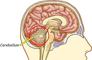 Cerebellar stroke 